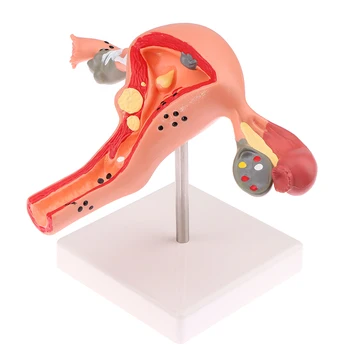 1 шт. медицинский реквизит Модель Патологической матки Анатомическая модель яичников Инструмент для изучения анатомического сечения
